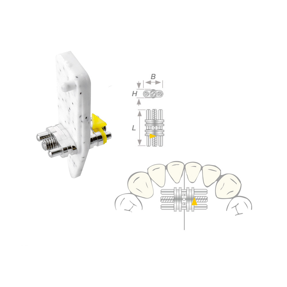 Dehnschraube Vector 100 mini 50St