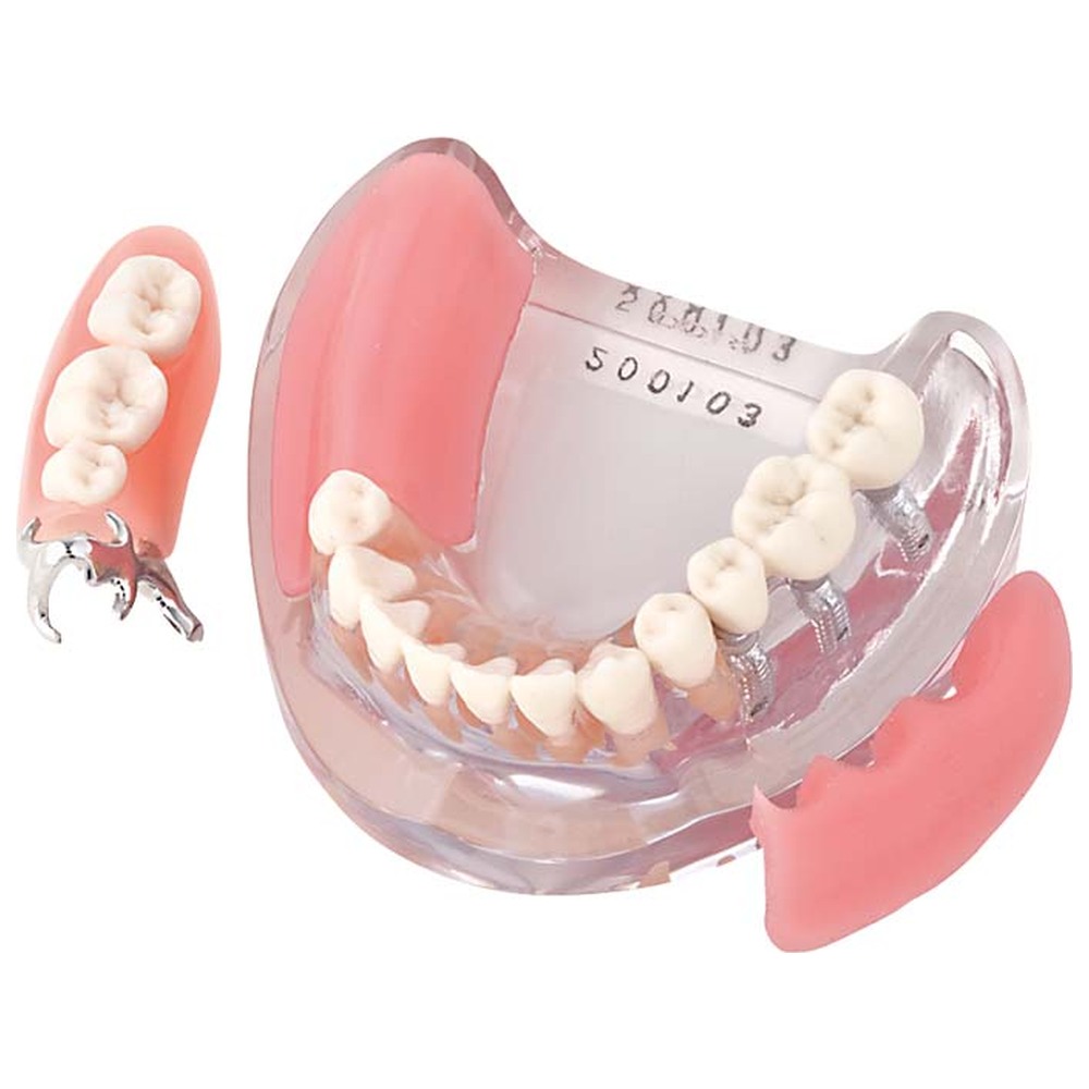 Morita Implantmodell UK mit Krone + Prothese iP9-3100 - Stück