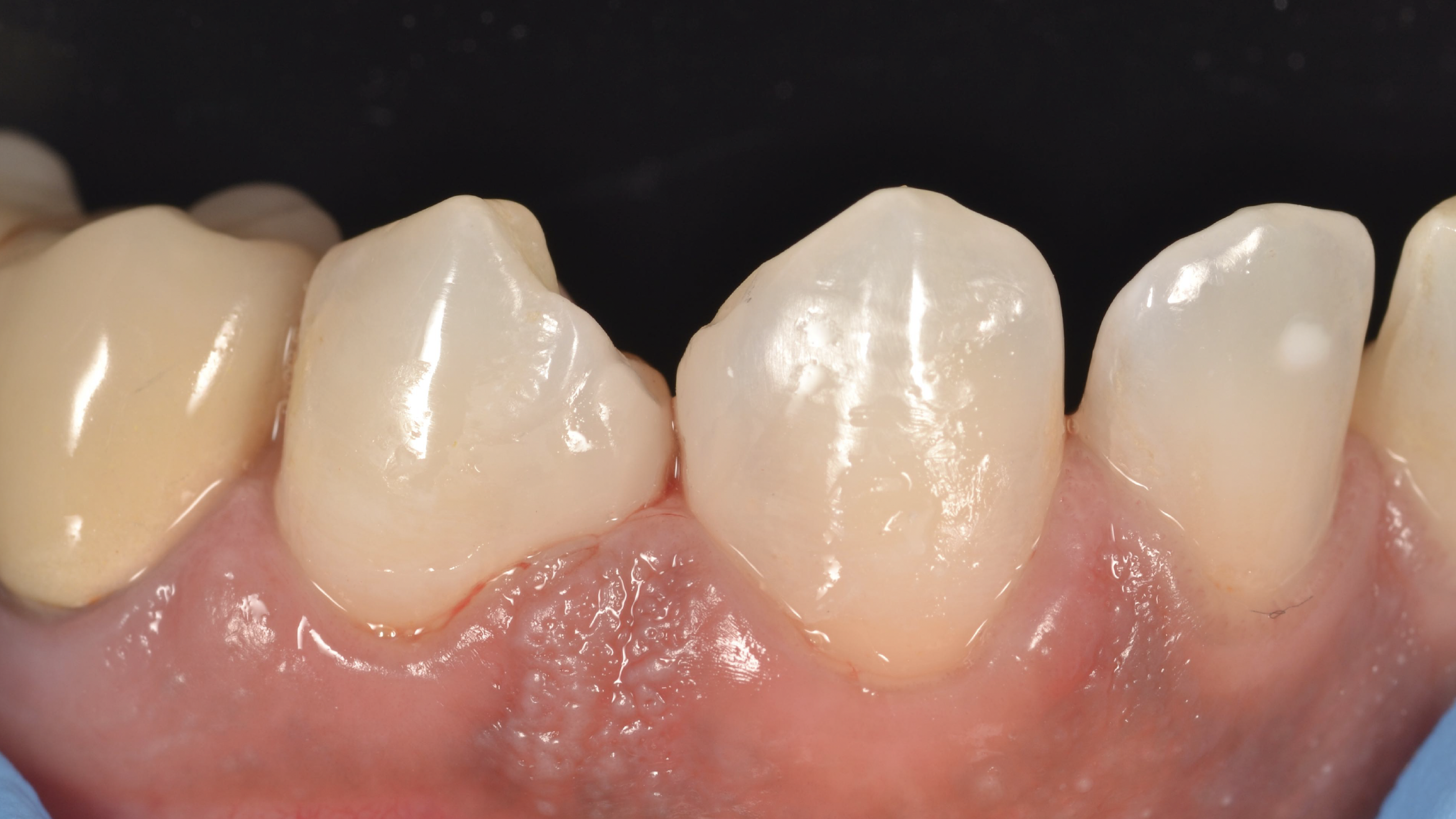 Nachher Diastema Schluss