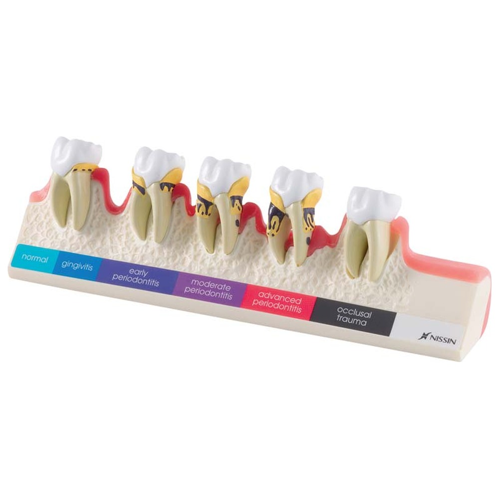 Morita Demonstrationsmodell „Parodontose-Stadien“ P23-PD1 - Stück
