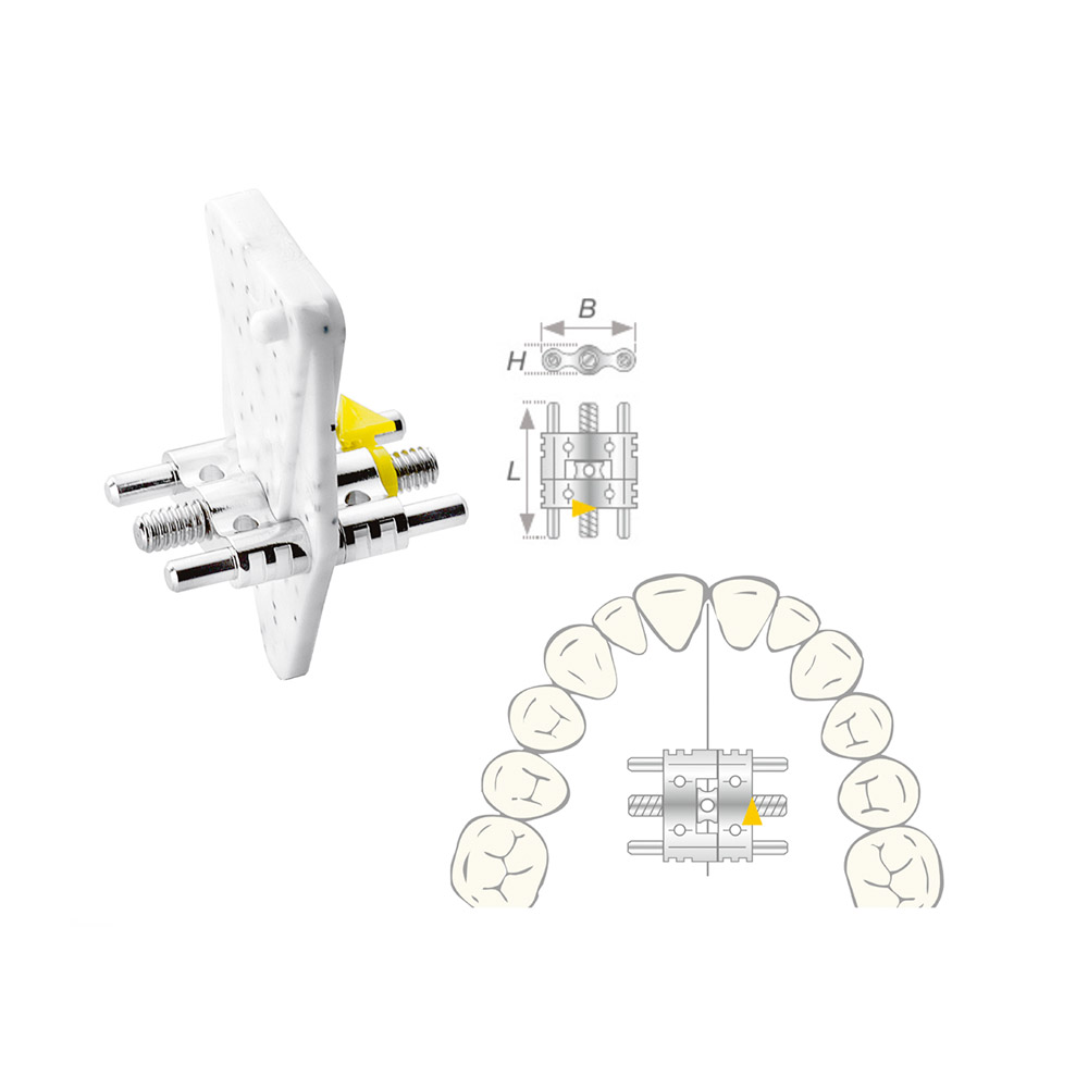 Dehnschraube Vector 190 medium 50St
