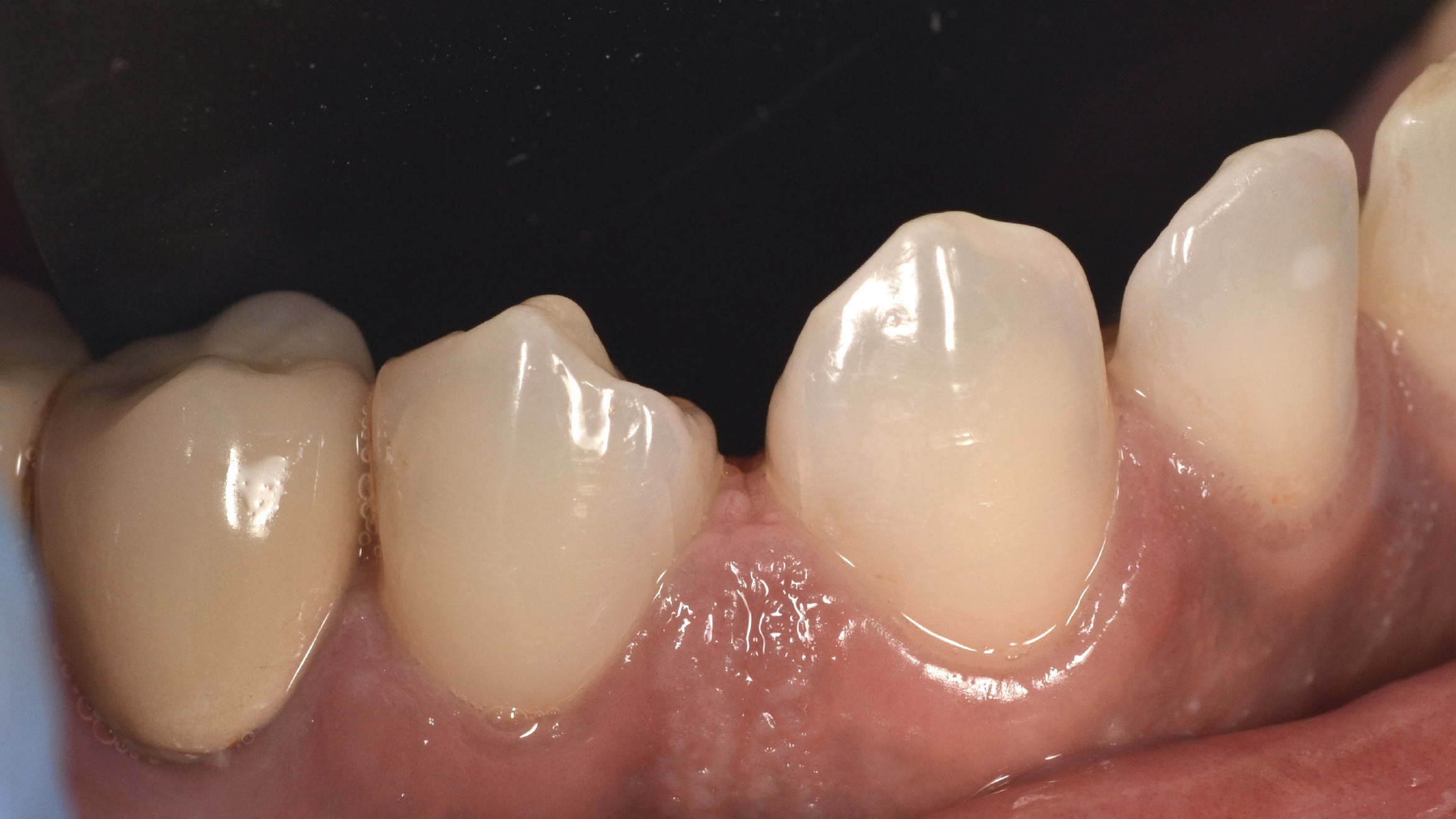 Vorher Diastema Schluss