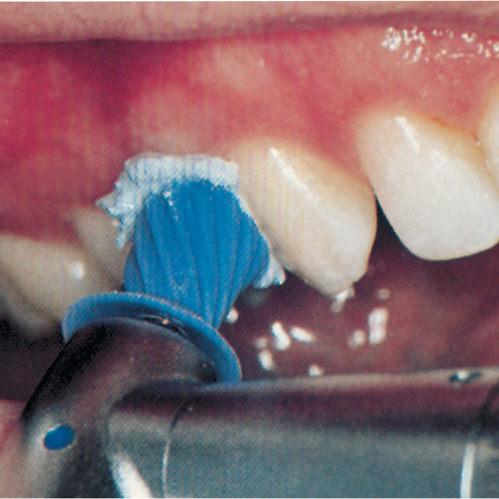 GX89463_ProCup_ScrewType_1810_120er_Pa Pro-Cup Screw-Type 1810 120er Pa